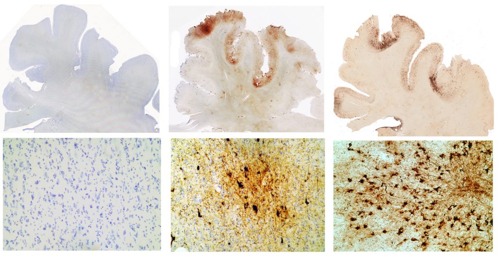 Effects of CTE on the brain