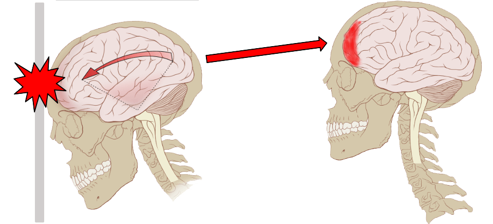 concussioninjury University of Miami Concussion Program
